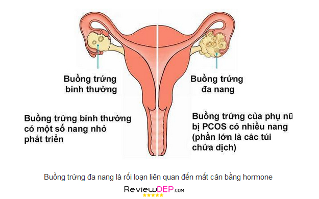 Buồng Trứng Đa Nang là gì?