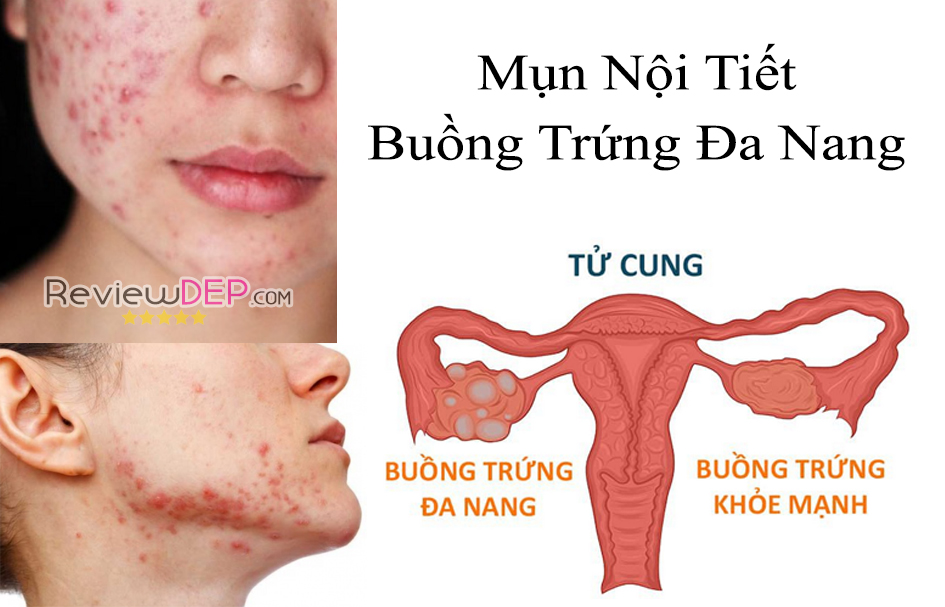 Cách trị mụn nội tiết do Buồng Trứng Đa Nang