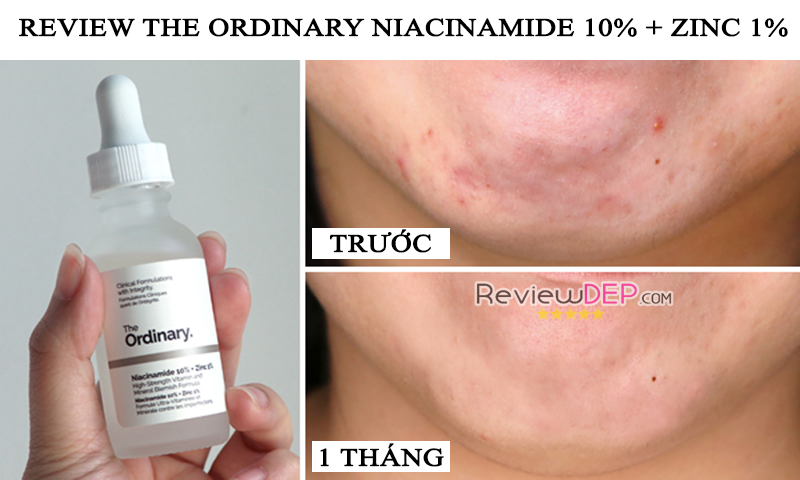 Review The Ordinary Niaciamide sau 1 tháng sử dụng