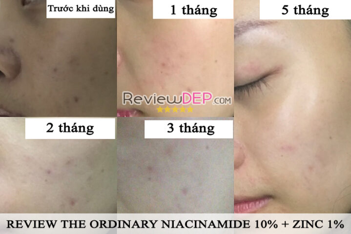 Review The Ordinary Niaciamide: sau khi dùng 5 tháng