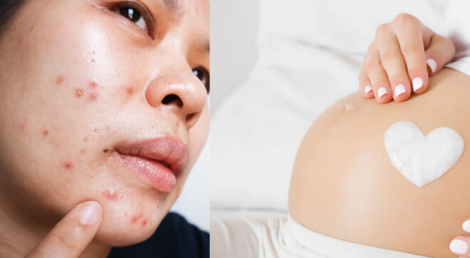 Cứu cánh cho bà bầu bị mụn